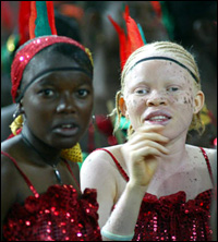 albino-girl-africa